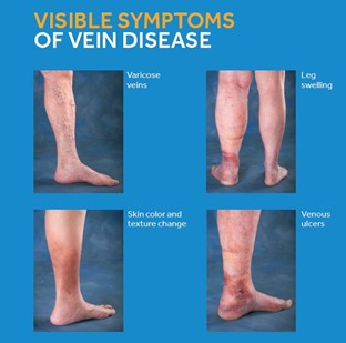 Venous Disease / Vein Clinic | Arizona Heart & Vascular Clinic